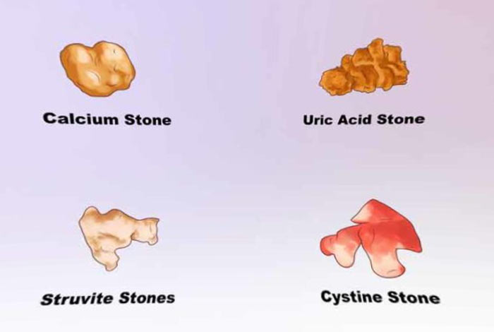 types and symptoms of kidney stone