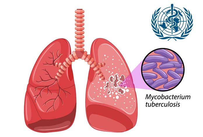 Tuberculosis Current Scenario and A Run through of Its Control Programm1