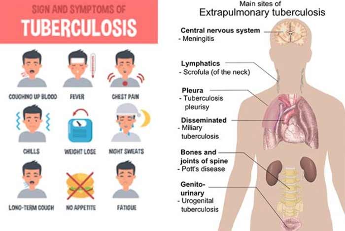 what are the causes of tuberculosis