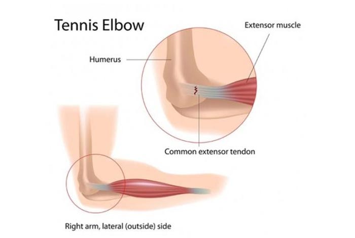 elbow tendinitis or tennis elbow