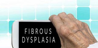 fibrous dysplasia symptoms causes diagnosis prevention and treatment