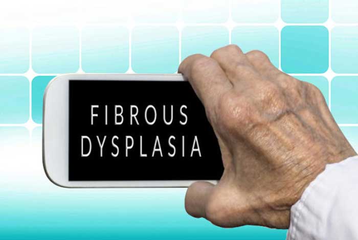 fibrous dysplasia symptoms causes diagnosis prevention and treatment