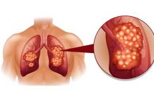 lung cancer types causes symptoms and treatment