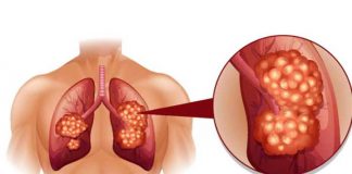 lung cancer types causes symptoms and treatment