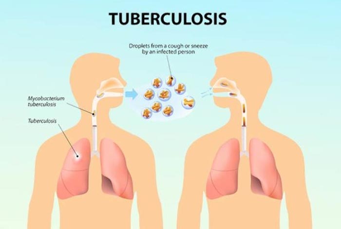  tuberculosis causes,-symptoms and treatmen