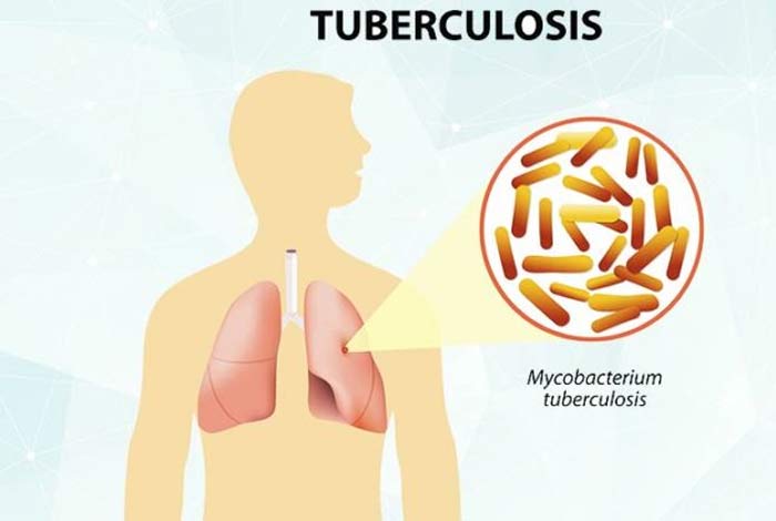 tuberculosis causes symptoms and treatment