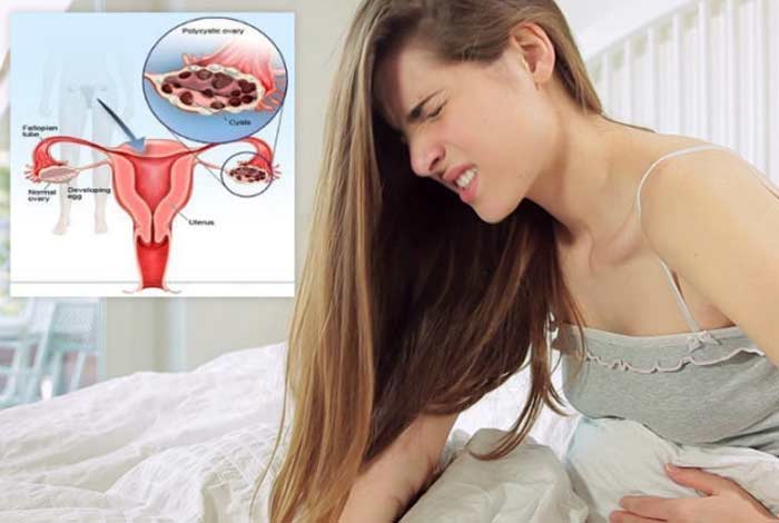 types and symptoms of pcos pcos