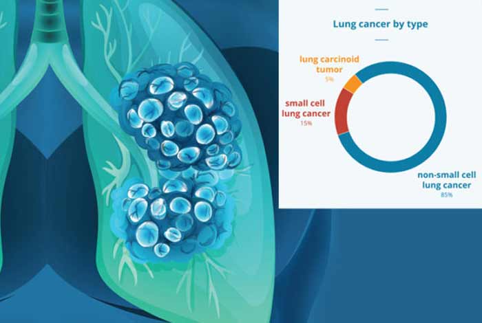 types of lung cancer