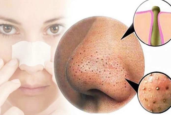 Simple Ways to Get Rid of Blackheads