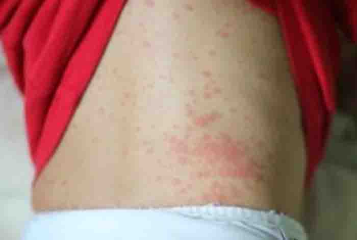appearance of rashes