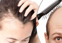alopecia types symptoms causes treatment