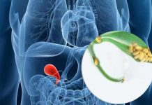 gallstones causes symptoms prevention and treatment