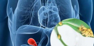 gallstones causes symptoms prevention and treatment