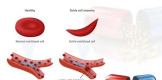 sickle cell anemia and its most common drug list