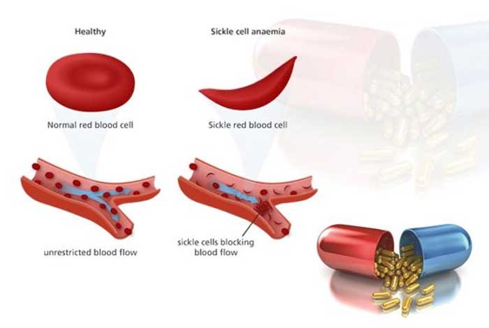sickle cell anemia and its most common drug list