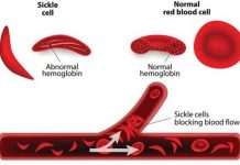 sickle cell anemia types symptoms causes diagnosis and treatment