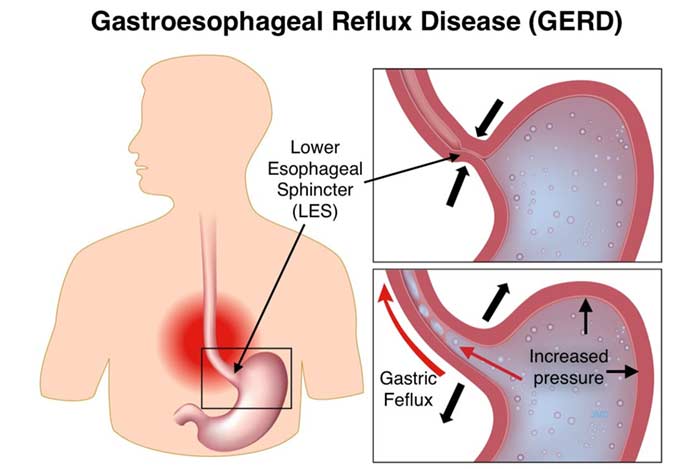 Gastroesophageal Reflux Disease (GERD) and Its Most Common Drug List