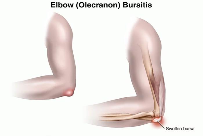 Elbow Bursitis