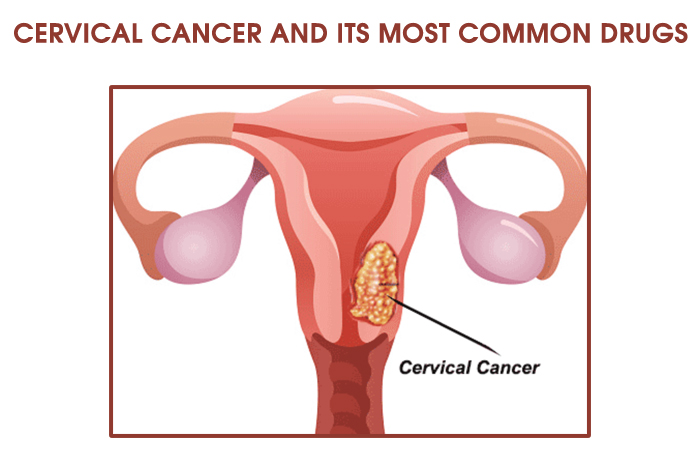 Cervical Cancer and its Most Common Drug List