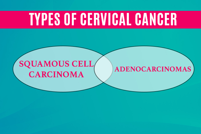 Types and Symptoms of Cervical Cancer