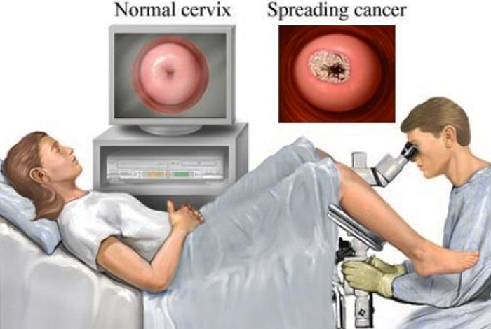 Diagnosis and Tests of Cervical Cancer