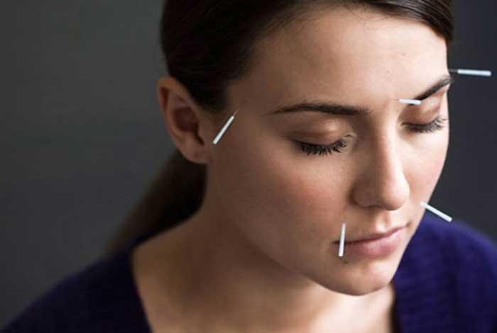acupuncture relieves stress in women undergoing fertility treatment