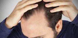male pattern baldness and its most common drug list