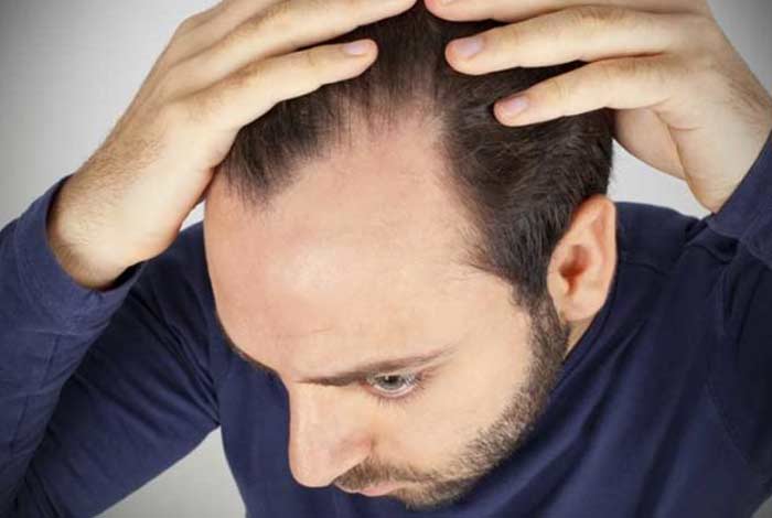 male pattern baldness and its most common drug list
