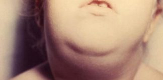 mumps and its most common drug list