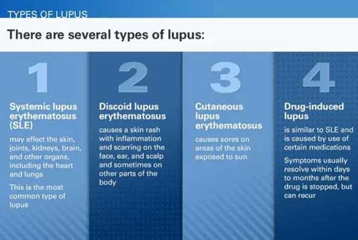 types and symptoms of lupus