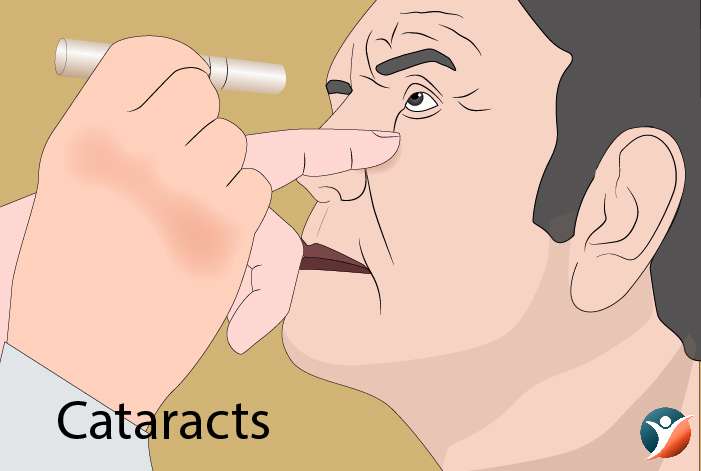 Cataracts: