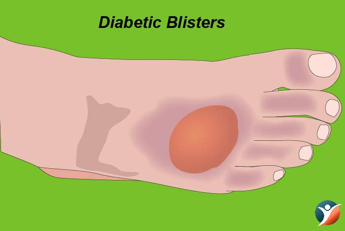 Diabetic Blisters
