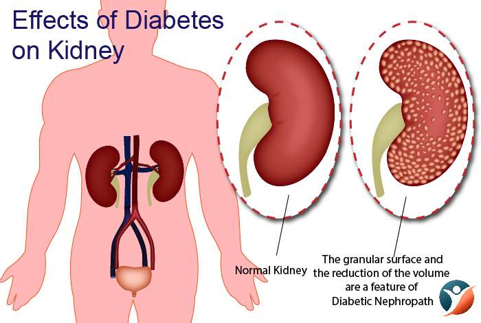 Risk Factors of Diabetes After Kidney Transplant