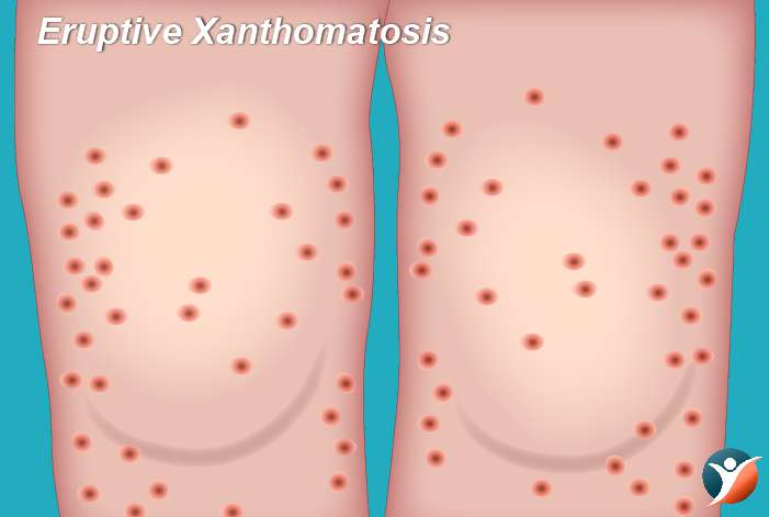 Eruptive Xanthomatosis