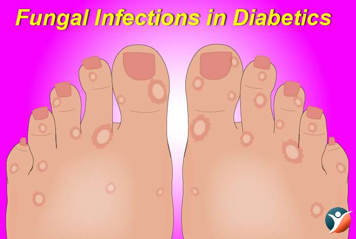 Fungal Infections in Diabetics