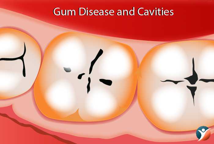 Gum-Disease-and-Cavities-in-diabetes