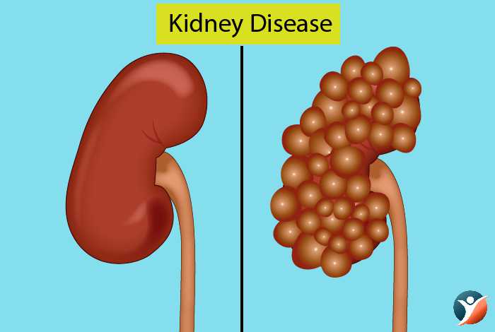 kidney problems during diabetes