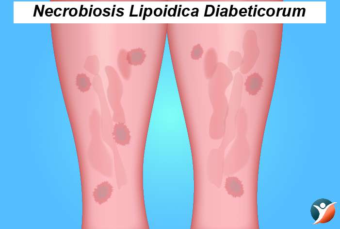 Necrobiosis Lipoidica Diabeticorum (NLD)