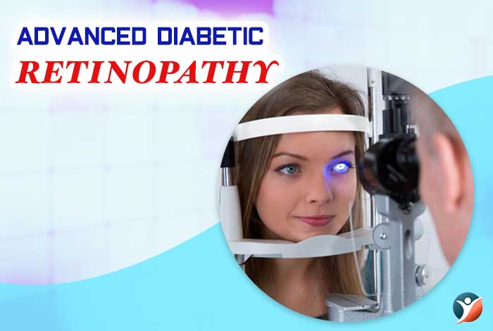 advanced diabetic retinopathy 