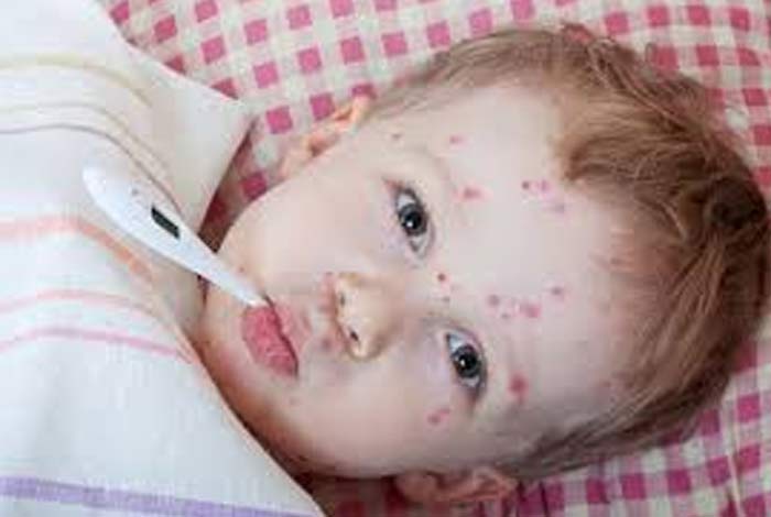 measles vs chickenpox symptoms