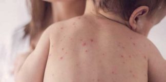 measles and chickenpox