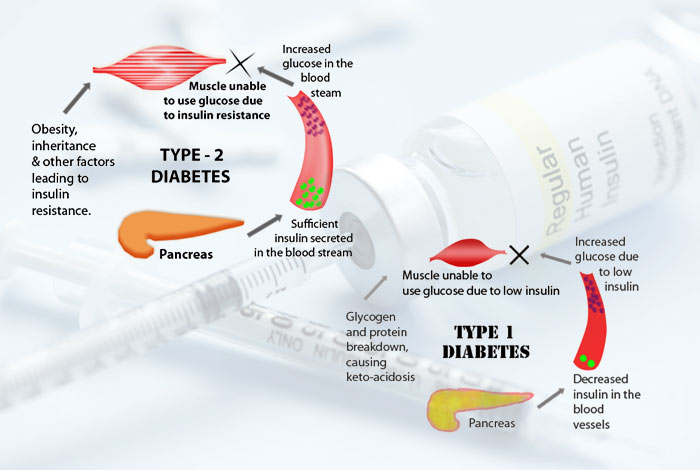 Type I Diabetes Mellitus