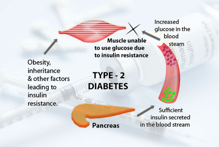 Type II Diabetes Mellitus