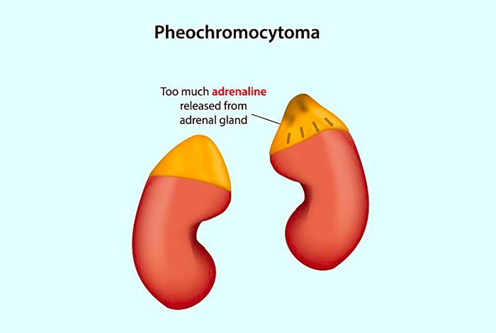 Pheochromocytomas