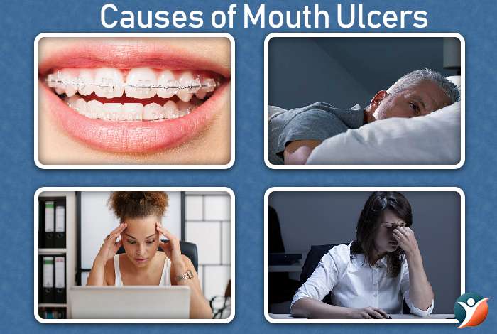 Causes of Mouth Ulcers