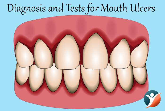 Diagnosis and Tests for Mouth Ulcers 