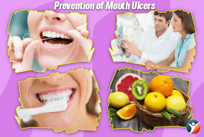 Prevention of Mouth Ulcers