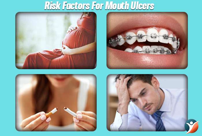Risk Factors For Mouth Ulcers