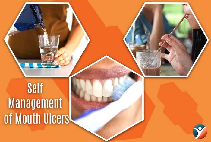 Self-Management of Mouth Ulcers 