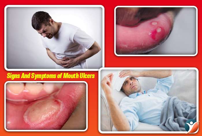 Signs And Symptoms of Mouth Ulcers